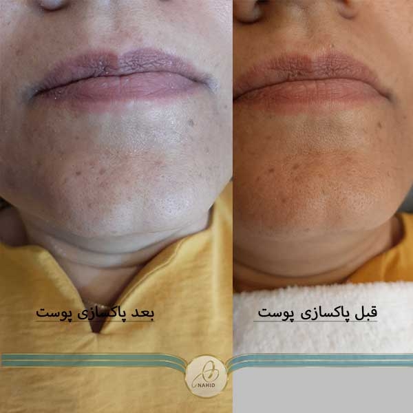 کاهش جوش های سر سیاه روشن شدن پوست کاهش خطوط دور چشم شفاف شدن