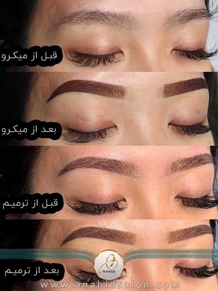 قبل و بعد از میکروبلیدینگ