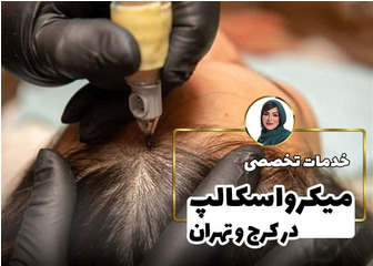 اسکالپ کف سر (میکرواسکالپ مو)