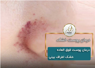 درمان پوست فوق العاده خشک اطراف بینی