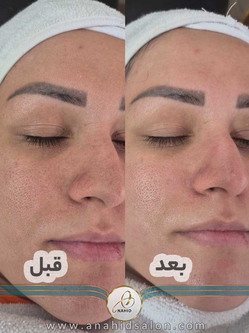 پاکسازی پوست در کرج