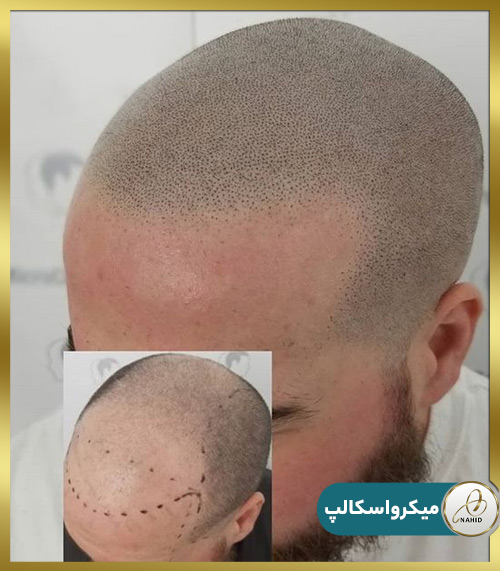 مراحل اجرای اسکالپ