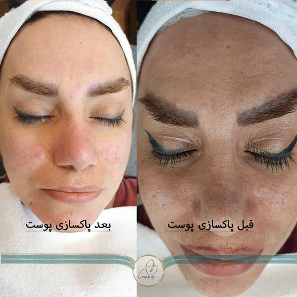 تخلیه جوش های سر سیاه لایه برداری آبرسانی پوست