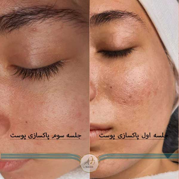 جلسه-سوم-پاکسازی-پوست