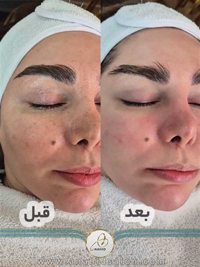 پاکسازی-پوست-و-فیشیال-آناهید-قبل-و-بعد
