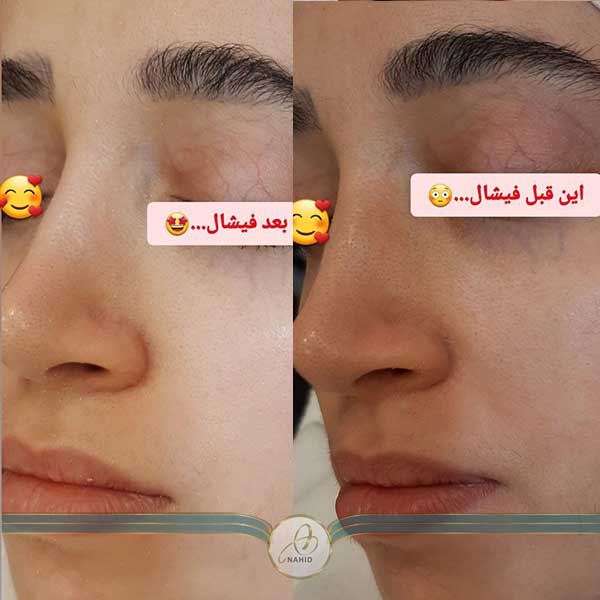 کاهش-جوش-های-سرسیاه-روشن-کننده-پوست-یکدست-شدن-پوست